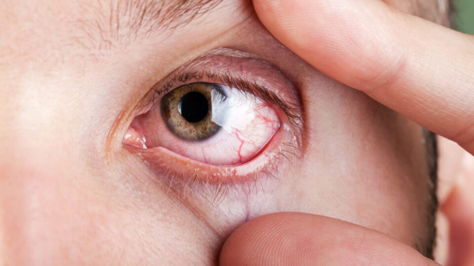 Ardência frequente nos olhos não deve ser ignorada; veja quando buscar ajuda