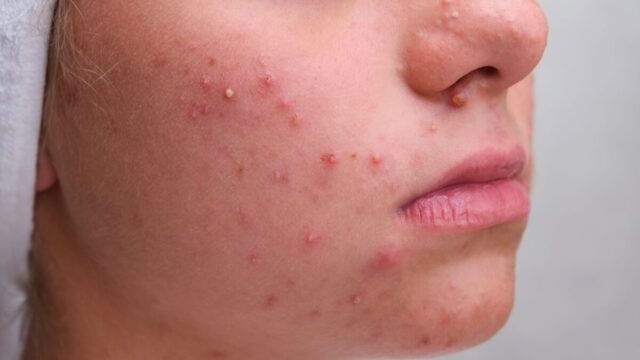 Estresse pode aparecer no rosto: entenda por que acne e coceira pioram
